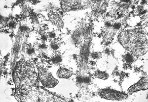 F,76y. | rhabdomyoma - tongue F,76y. | rhabdomyoma - tongue